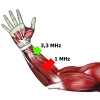 Schemat działania fal ultradźwiękowych 1 MHz i 3,3 MHz w terapii mięśni.
